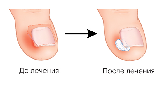 Лечение вросшего ногтя в Барнауле